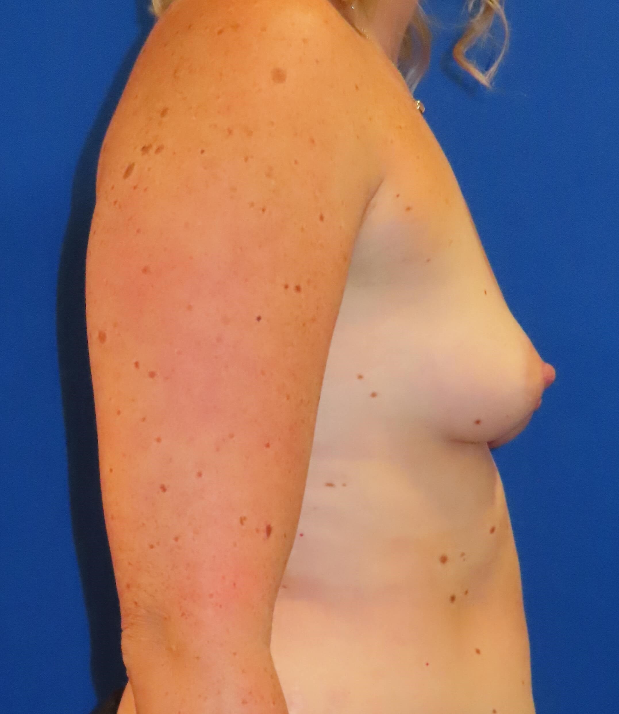 Right Side View Before