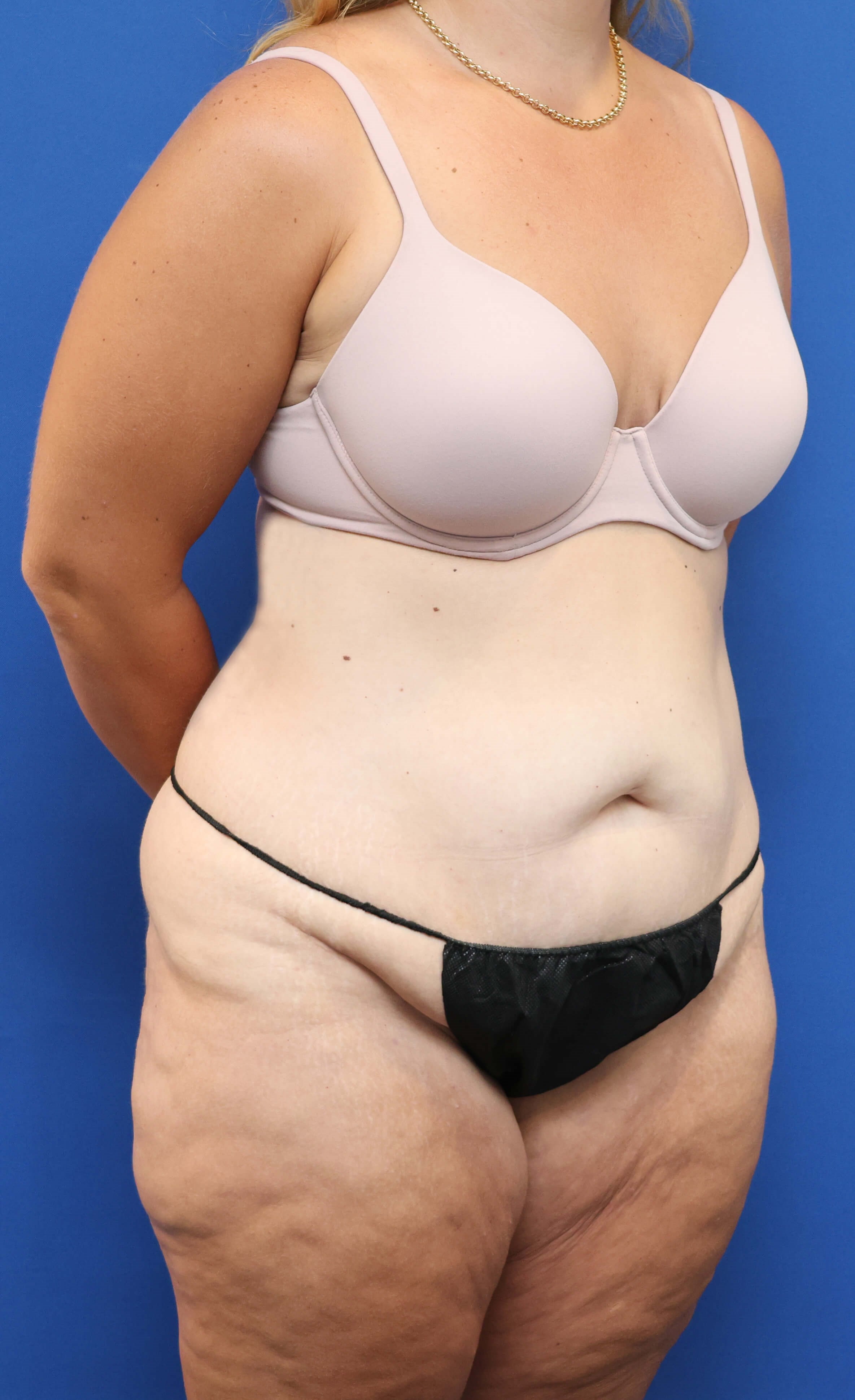 Right Oblique View Before