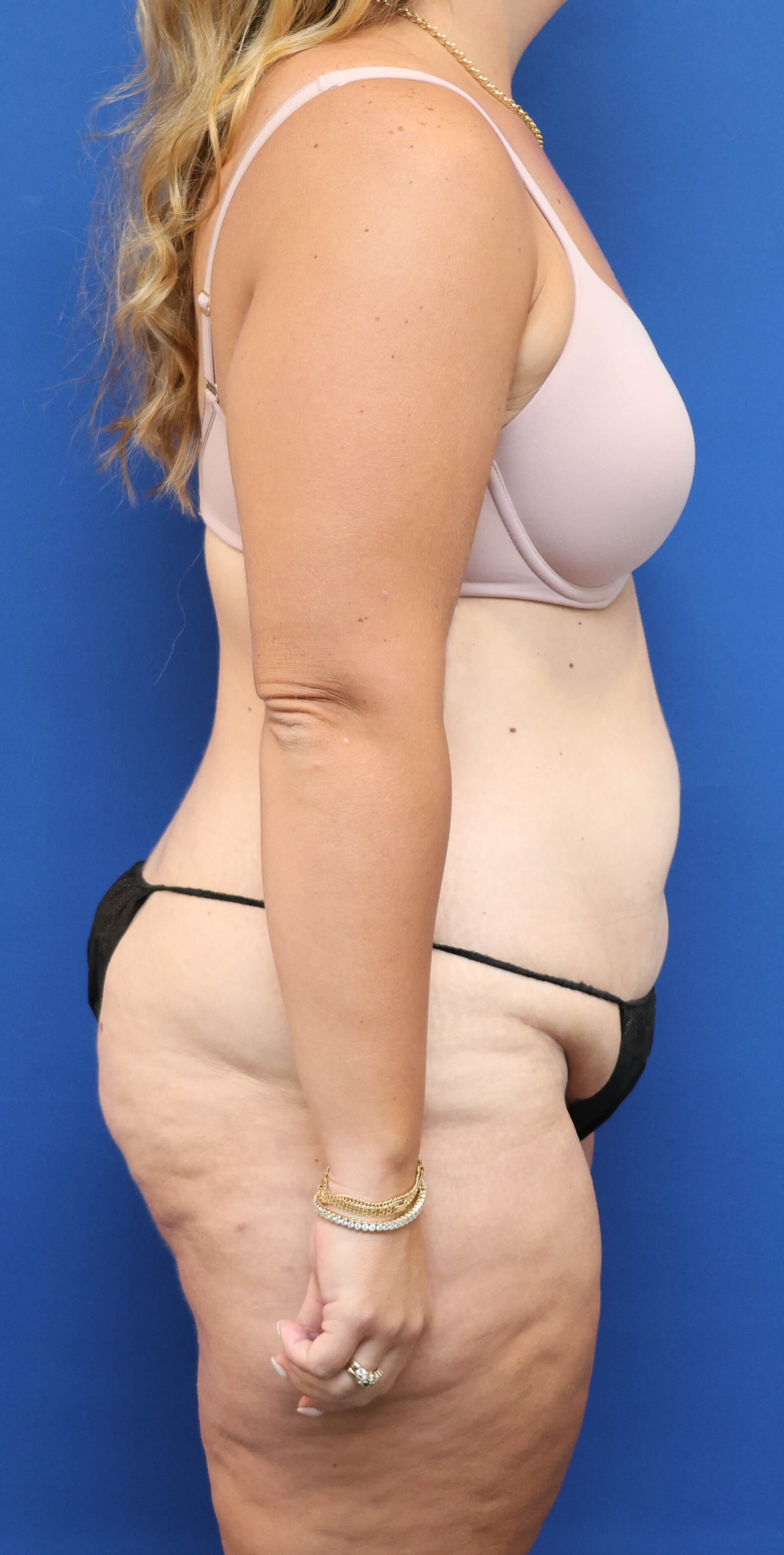 Right Side View Before