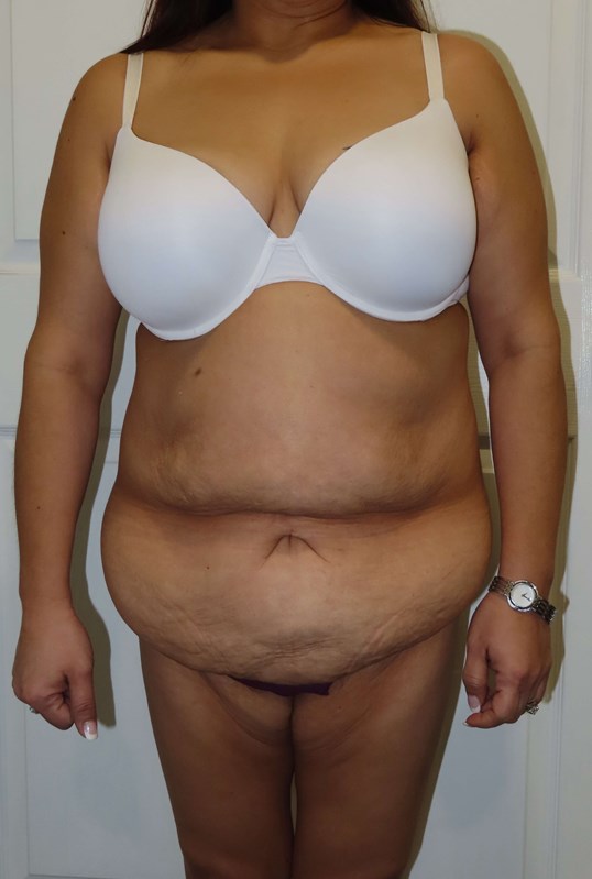 The Fleur-de-lis Abdominoplasty after Massive Weight Loss